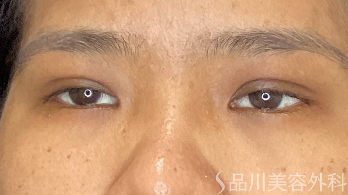 症例NO.72198のAFTER写真