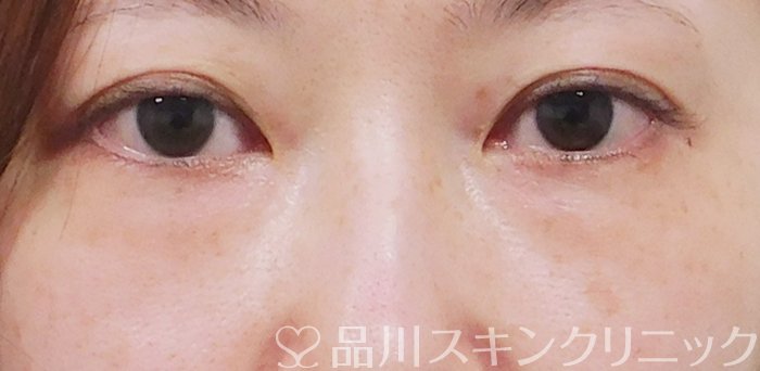 症例NO.63082のBEFORE写真