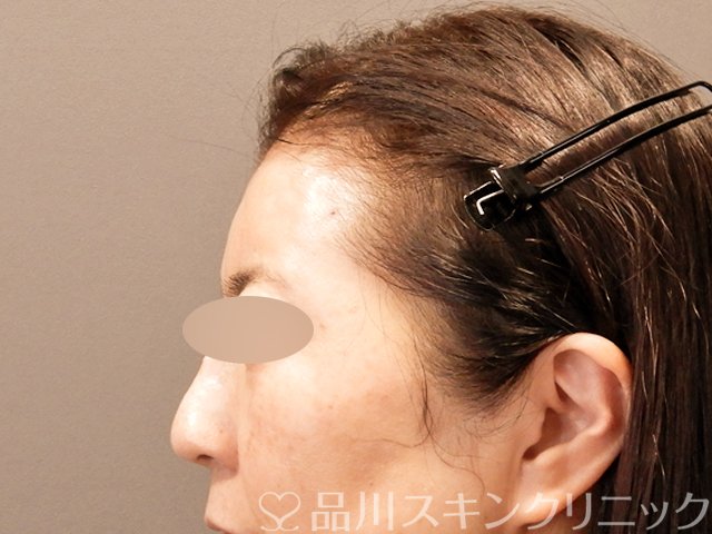 症例NO.71084のAFTER写真