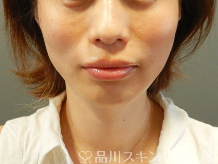 症例NO.65709のAFTER写真