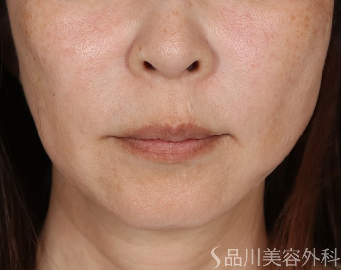 症例NO.71012のAFTER写真