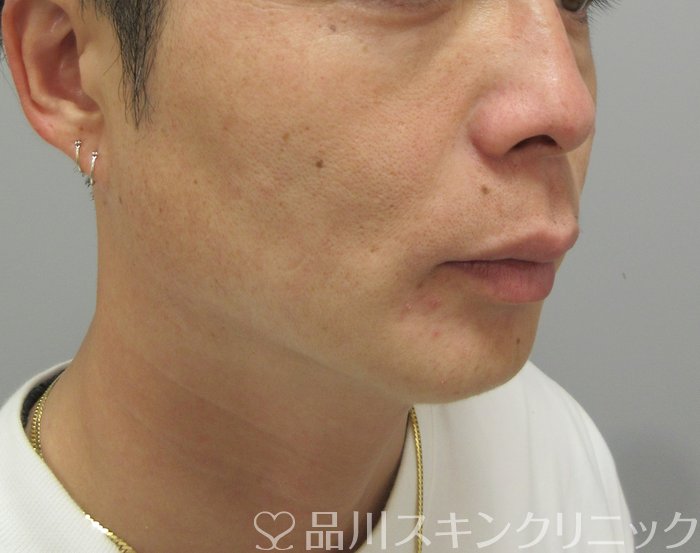 症例NO.73746のAFTER写真