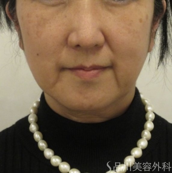 症例NO.72548のBEFORE写真