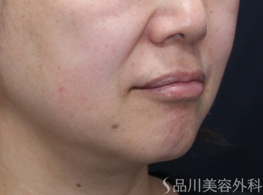 症例NO.74926のBEFORE写真