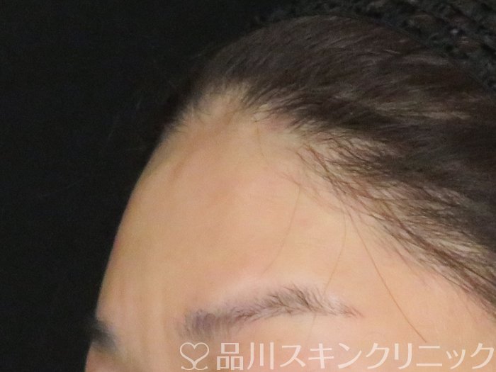 症例NO.65586のAFTER写真