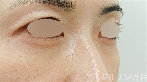 症例NO.49211のAFTER写真