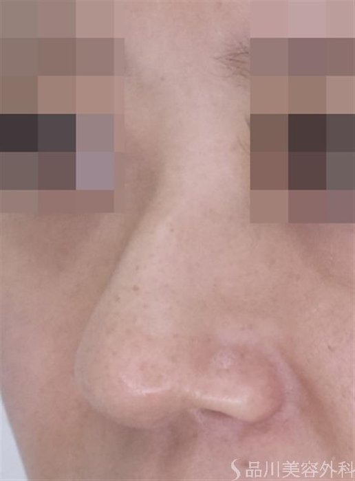 症例NO.51562のBEFORE写真