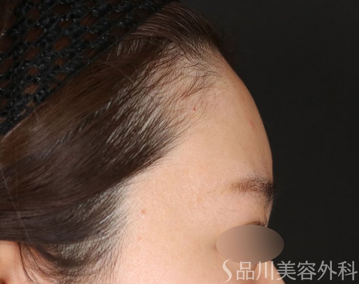 症例NO.73044のAFTER写真