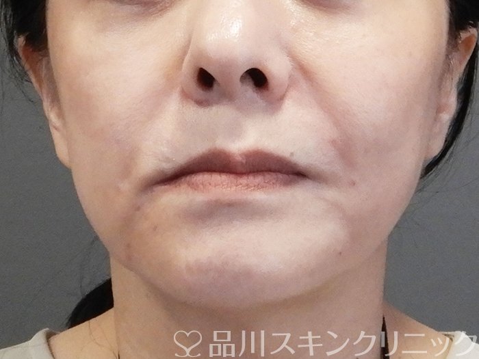 症例NO.75179のAFTER写真
