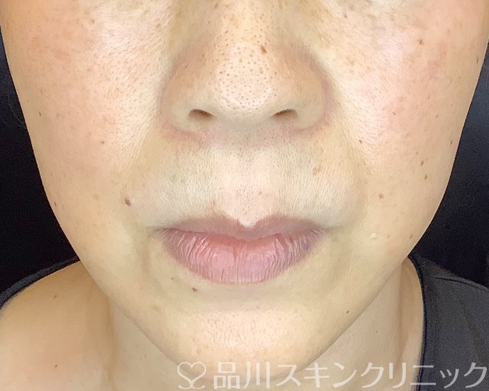症例NO.67027のAFTER写真