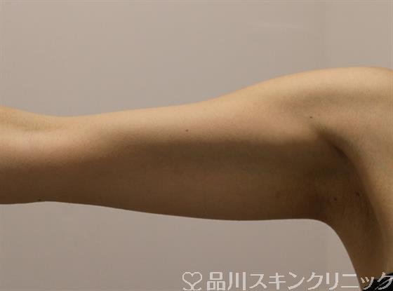 症例NO.49434のBEFORE写真