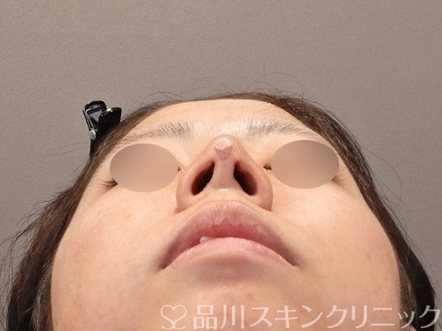 症例NO.75198のAFTER写真