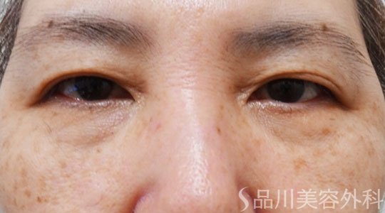症例NO.69437のAFTER写真