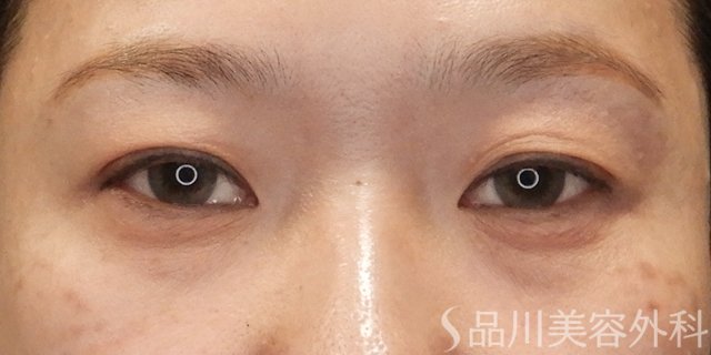 症例NO.73297のBEFORE写真