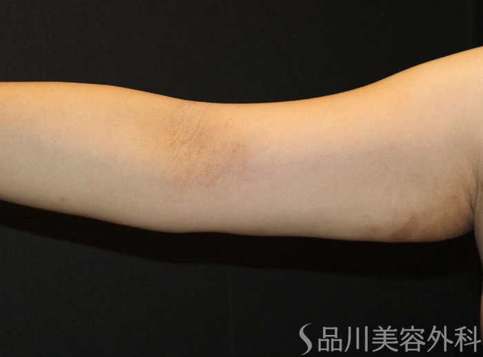 症例NO.73741のAFTER写真