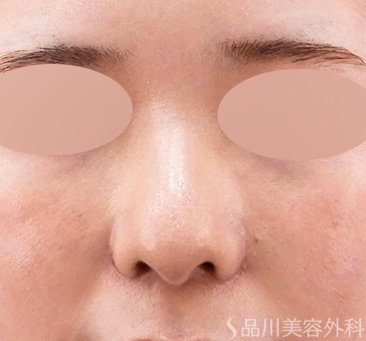 症例NO.62702のAFTER写真