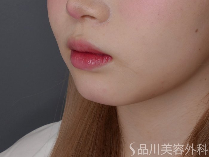症例NO.71716のBEFORE写真