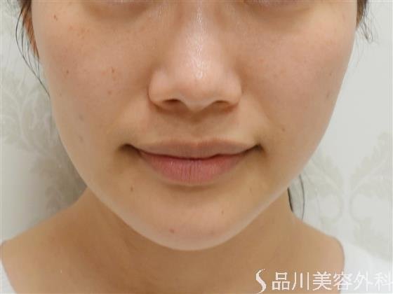 症例NO.47375のBEFORE写真