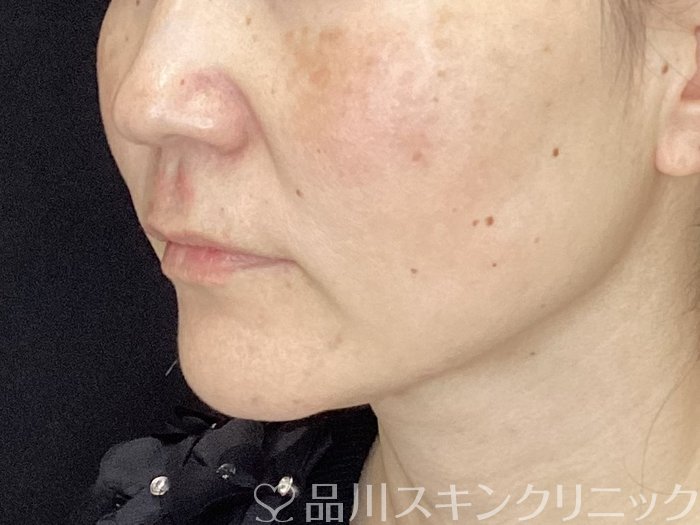 症例NO.72496のBEFORE写真