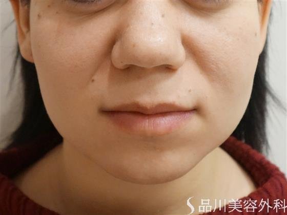 症例NO.41751のBEFORE写真