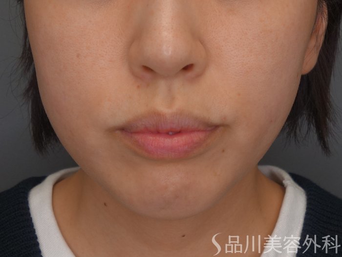 症例NO.67706のBEFORE写真