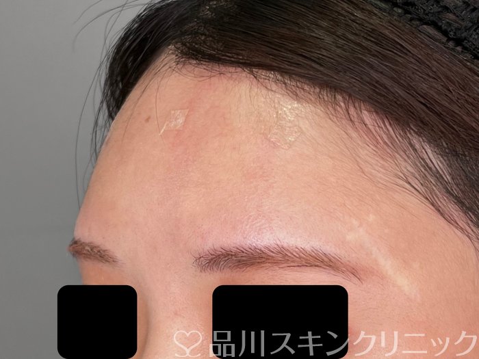 症例NO.70001のAFTER写真