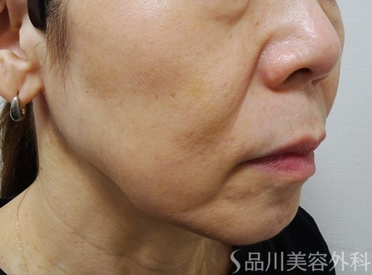 症例NO.69883のBEFORE写真