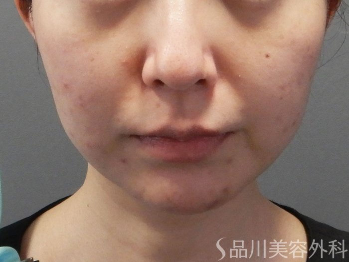 症例NO.72591のBEFORE写真