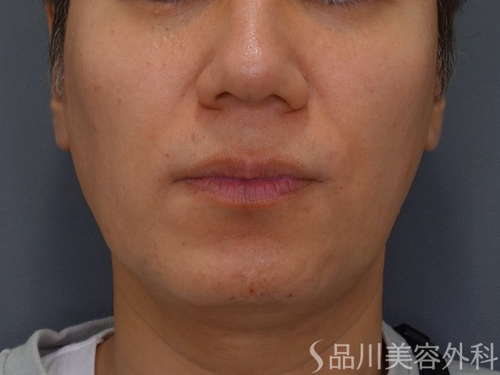 症例NO.75344のBEFORE写真