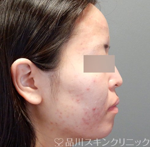 症例NO.70456のAFTER写真
