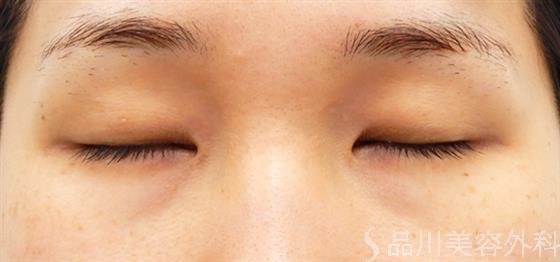 症例NO.53089のBEFORE写真