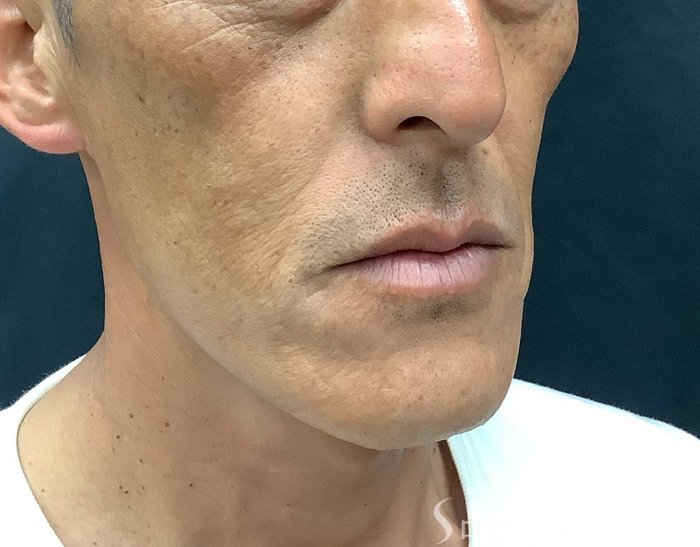 症例NO.71042のBEFORE写真