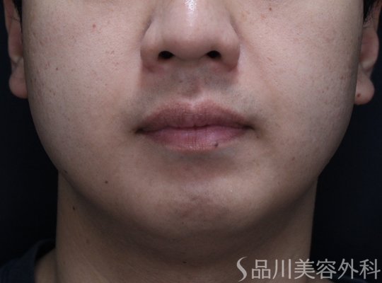 症例NO.72147のBEFORE写真