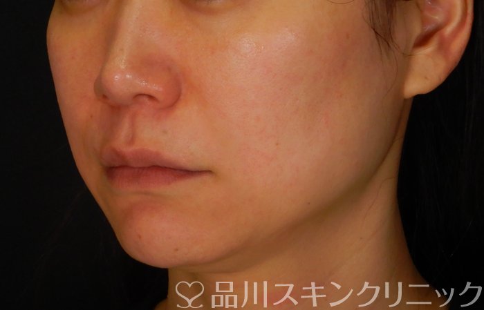 症例NO.65676のBEFORE写真