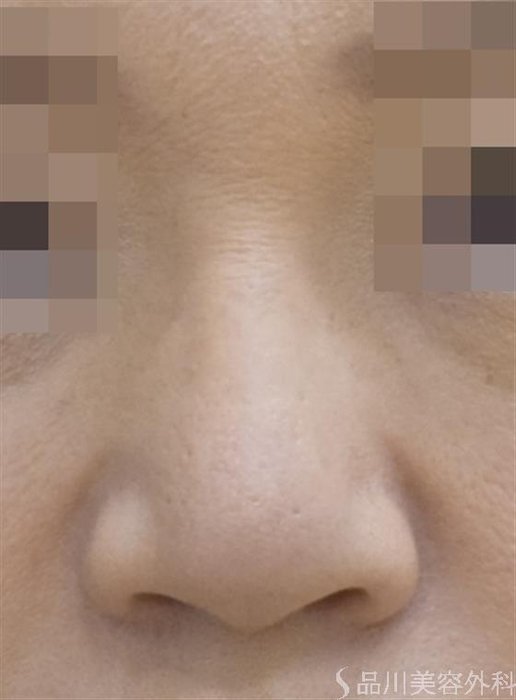 症例NO.48540のAFTER写真