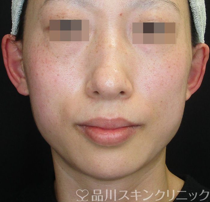 症例NO.74042のBEFORE写真