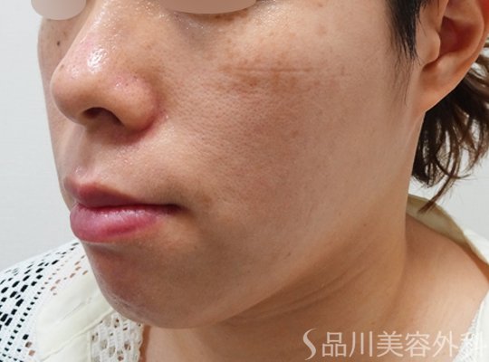 症例NO.71189のAFTER写真