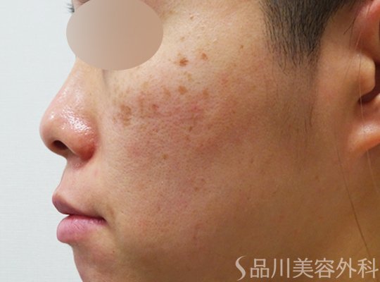 症例NO.71189のBEFORE写真