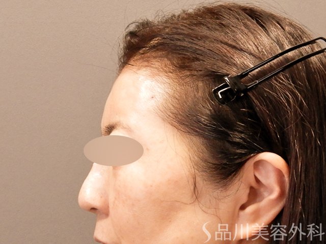 症例NO.71084のAFTER写真