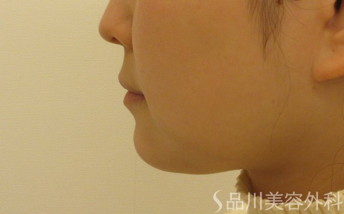 症例NO.70743のBEFORE写真