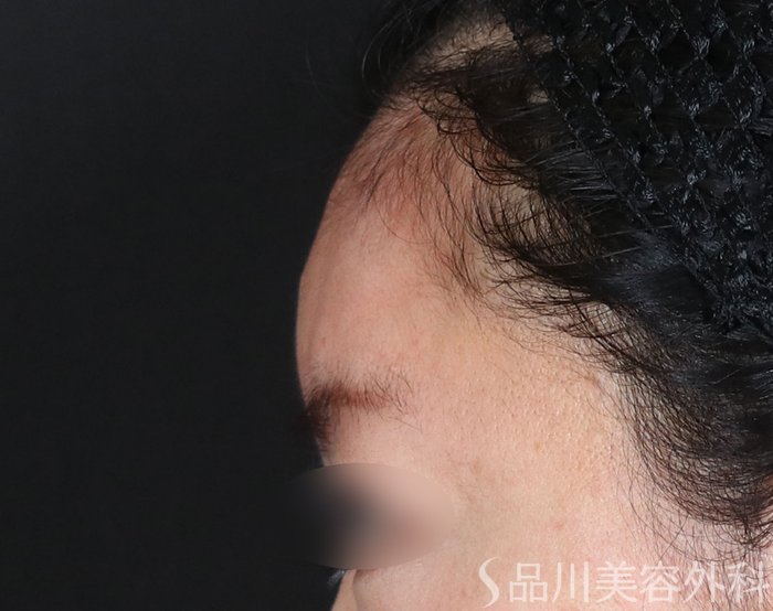 症例NO.74153のAFTER写真