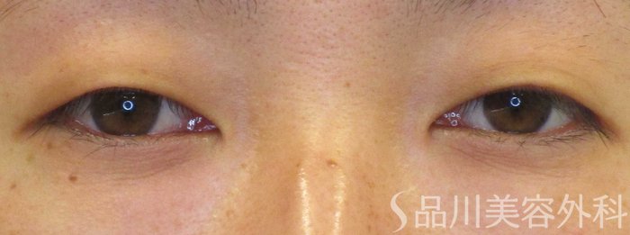 症例NO.69227のBEFORE写真