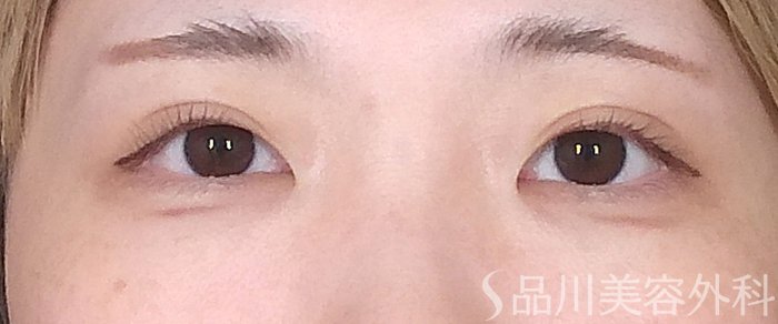 症例NO.65716のAFTER写真