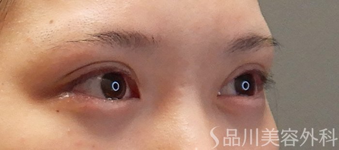 症例NO.71668のAFTER写真