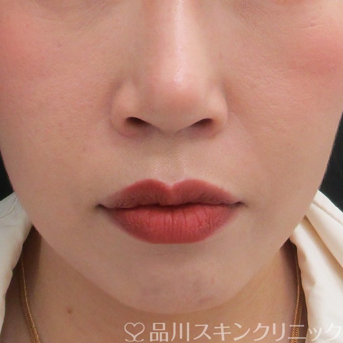 症例NO.75294のBEFORE写真