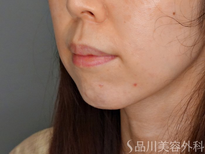 症例NO.70002のBEFORE写真