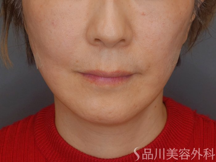 症例NO.72338のAFTER写真