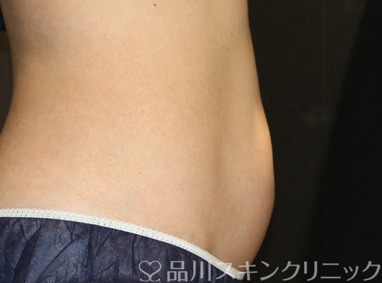 症例NO.74686のAFTER写真