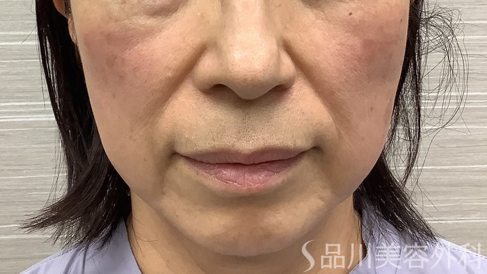 症例NO.62222のBEFORE写真
