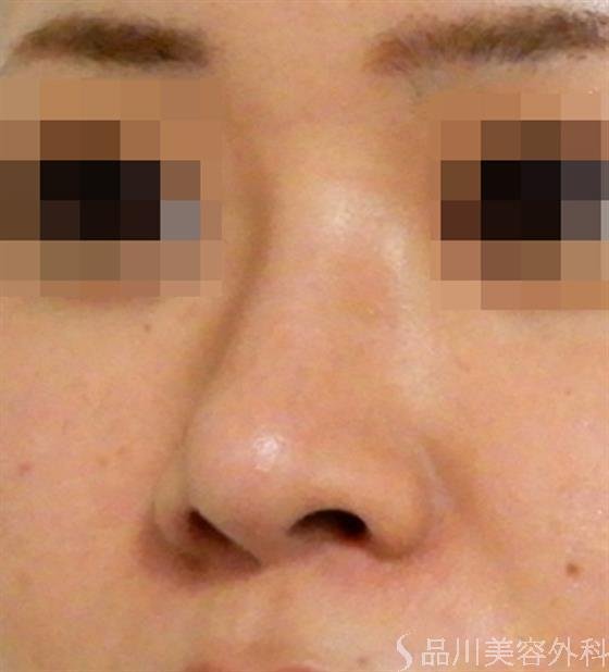 症例NO.37460のAFTER写真